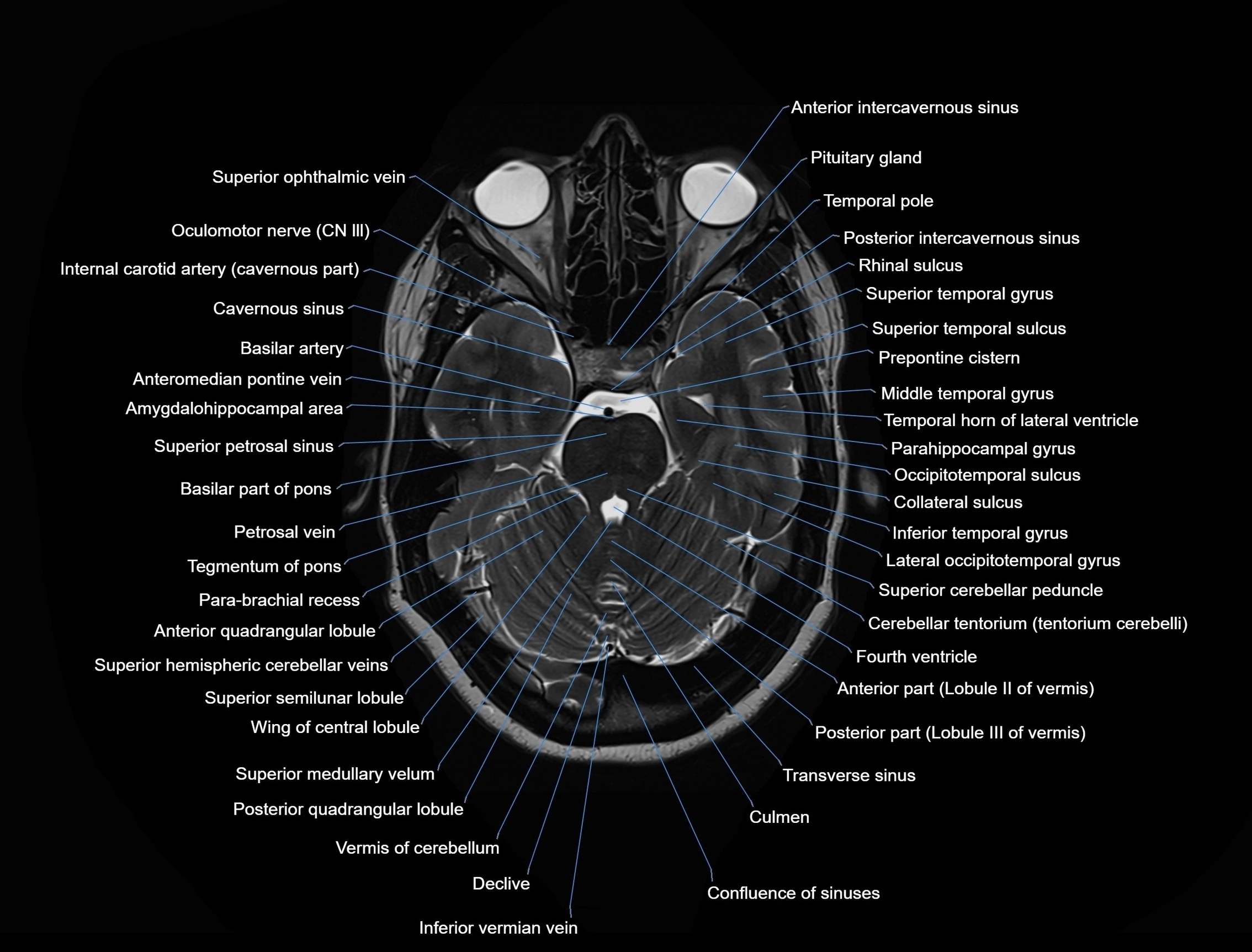 MRI Brain axial cross sectional radiology anatomy 3T image  -img-00001-00018.webp